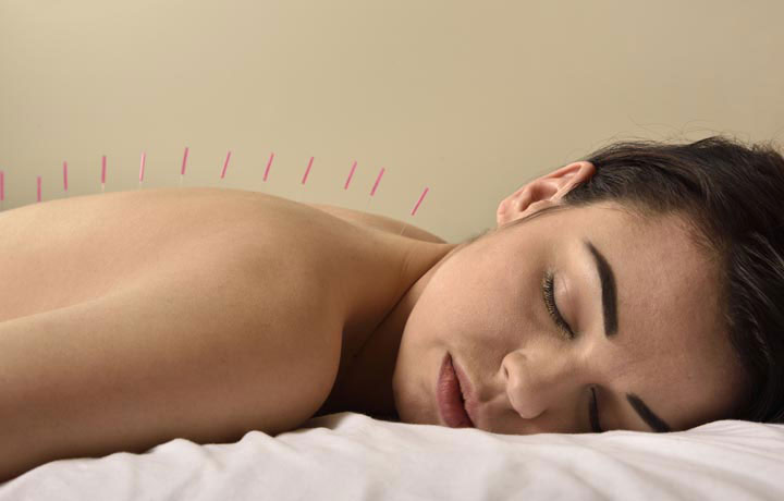 why acupuncture is good for women